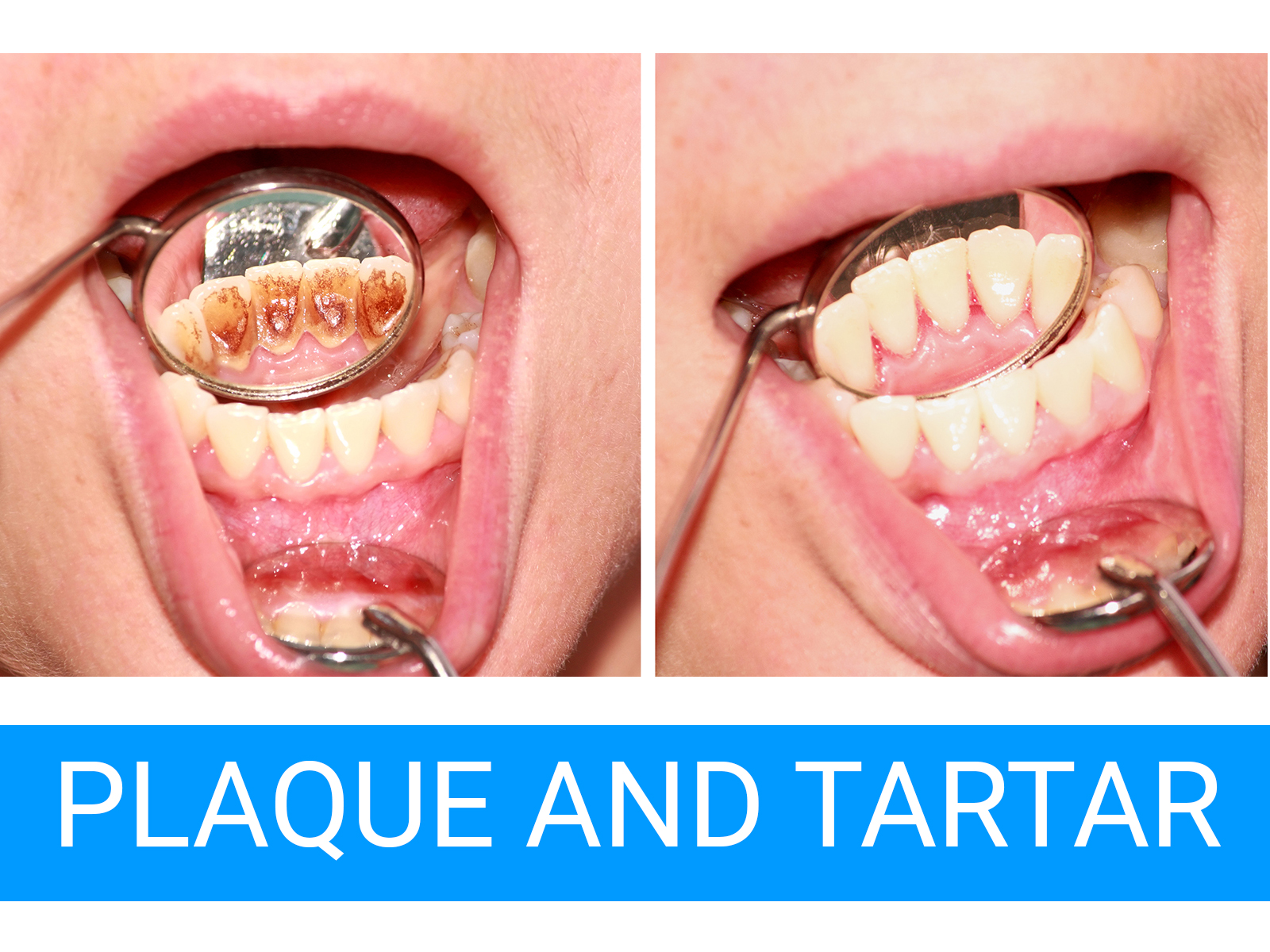 What is the difference between plaque and tartar?