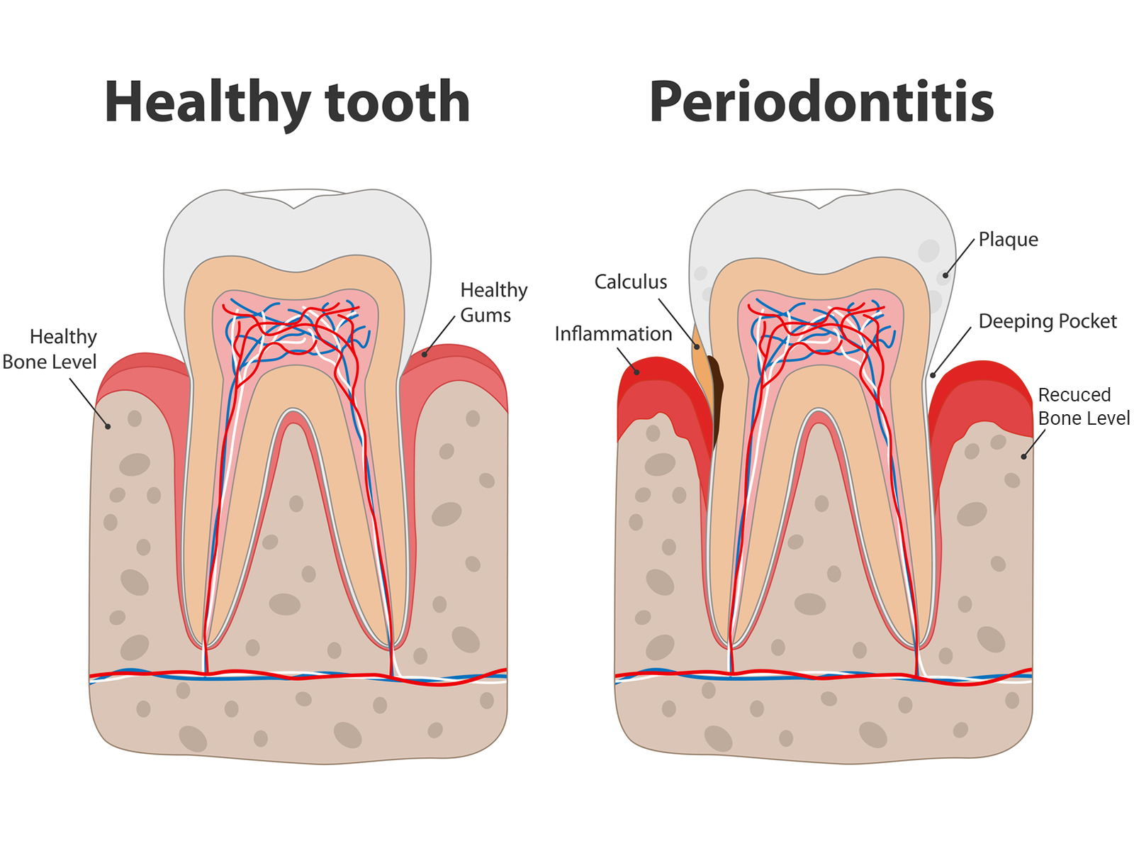 What is a Periodontal Pocket?