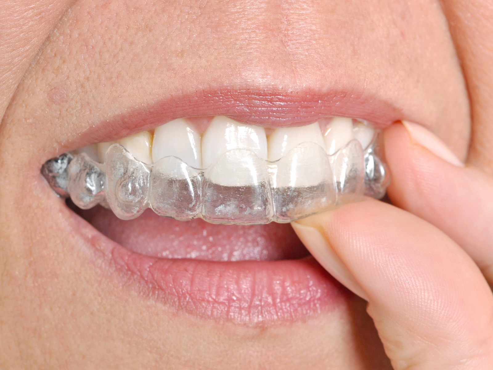 Who should not get Invisalign?