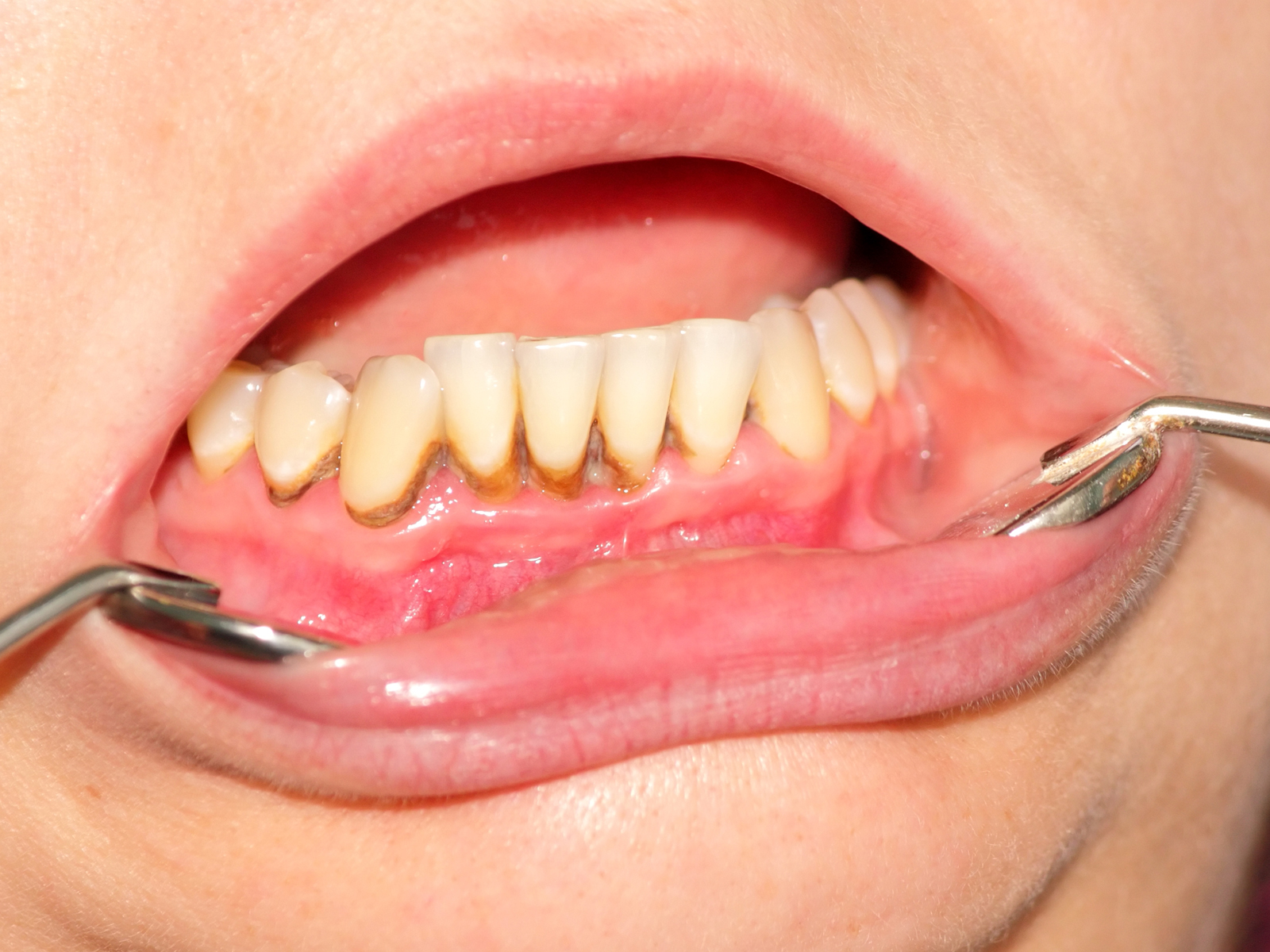 Does removing tartar loose teeth?