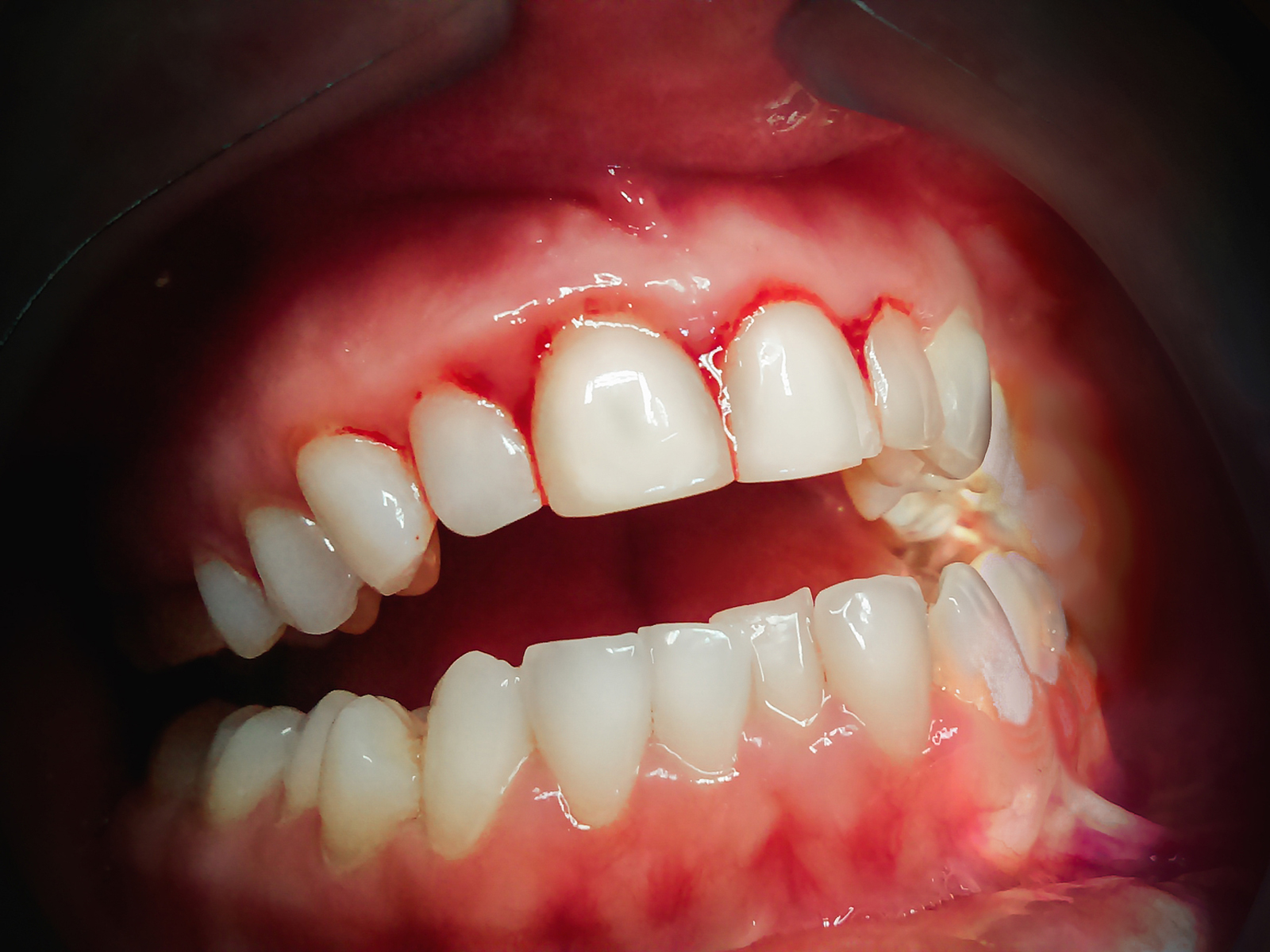 What happens if bleeding gums are not treated?