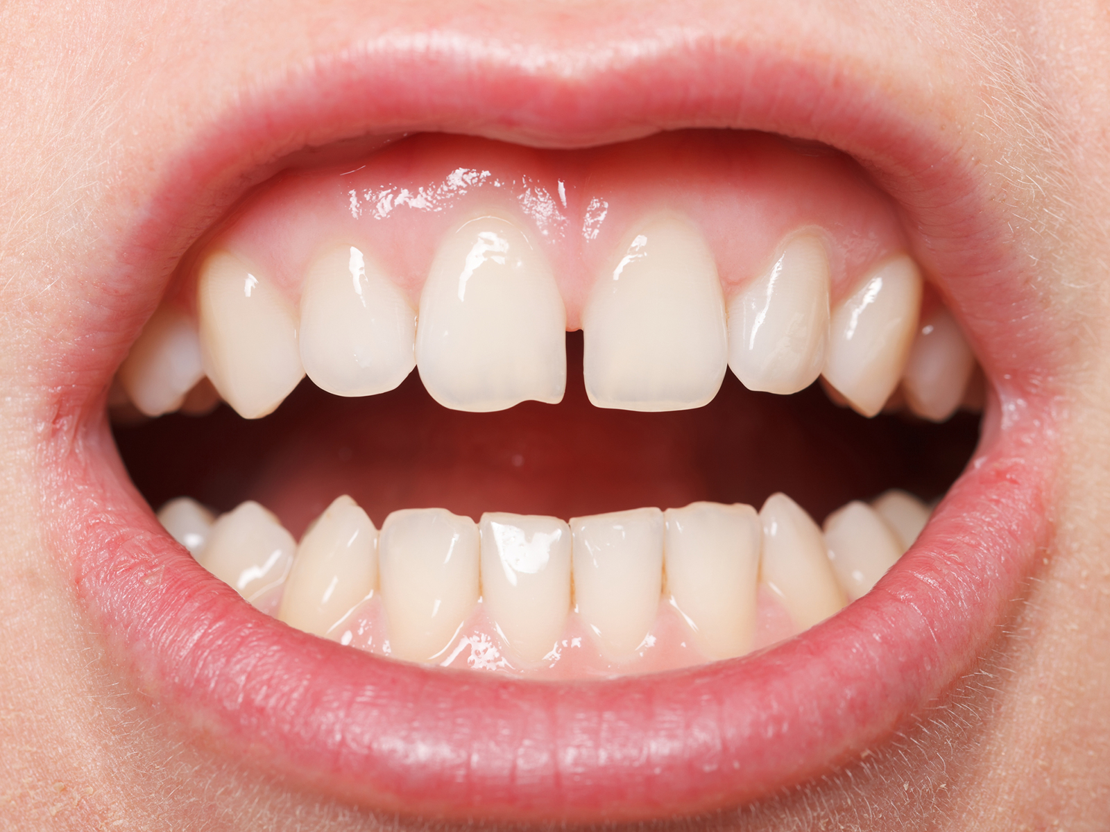 What Causes Crooked Teeth And How Can We Treat Them?