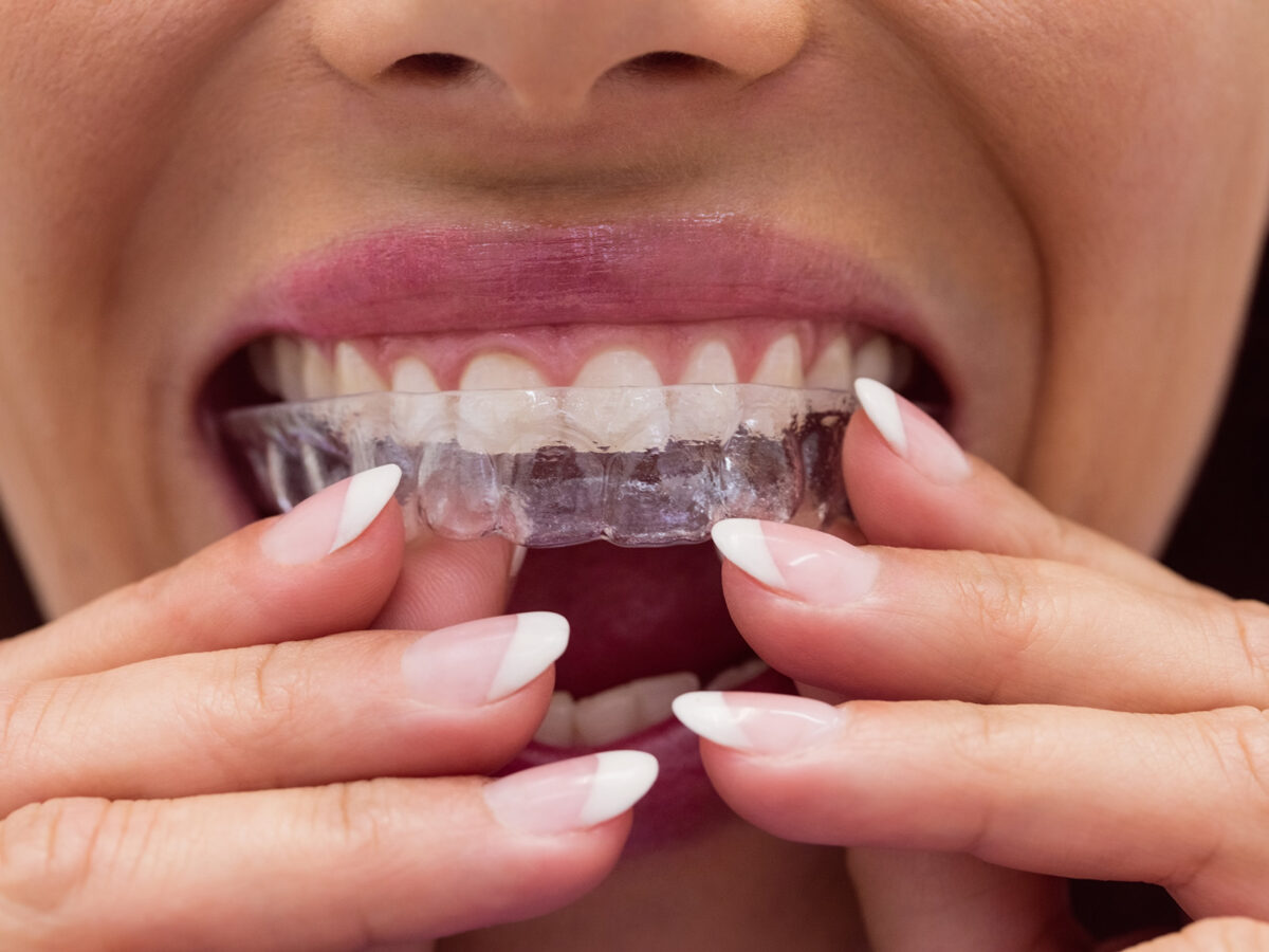 What Should I Do If My Invisalign Aligner Doesn't Fit?