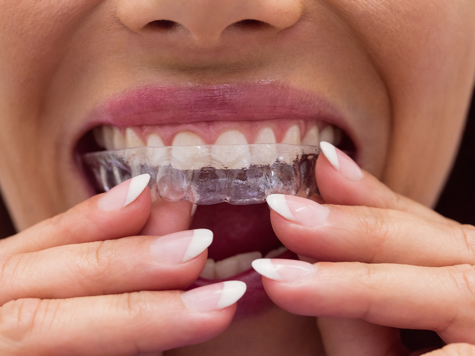 What Should I Do If My Invisalign Aligner Doesn’t Fit?