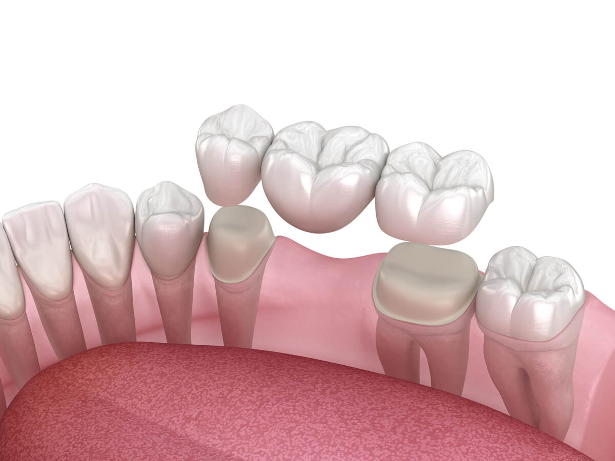 Dental Bridge Failure