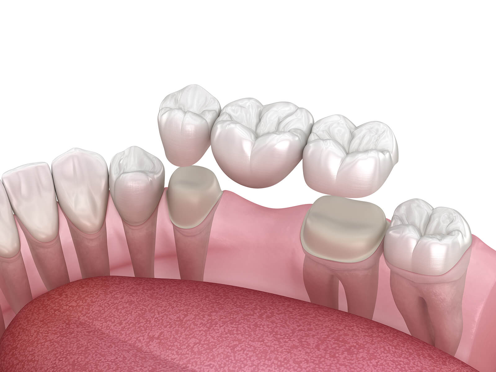 4 Common Causes of Dental Bridge Failure and How to Prevent Them