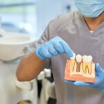 Complete Guide on How To Clean All-on-4 Dental Implants At Home
