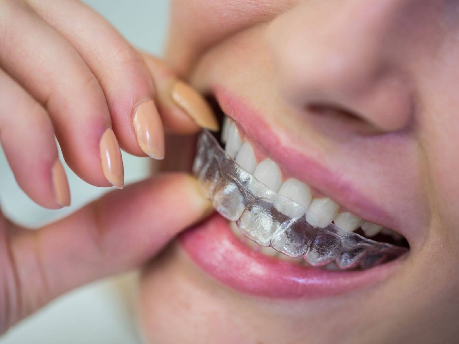 5 Signs It’s Time to Replace Your Teeth Grinding Guard