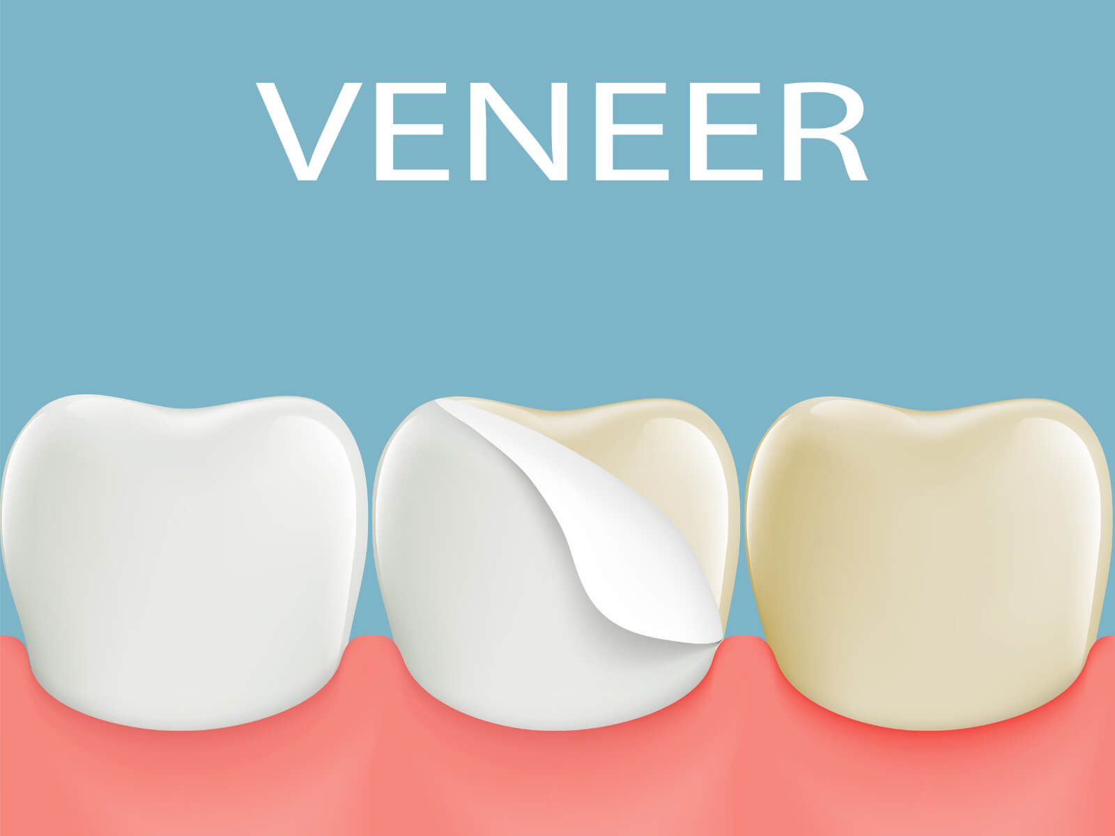Cosmetic Bonding Vs. Veneers: Which Is Right For Your Smile Goals?