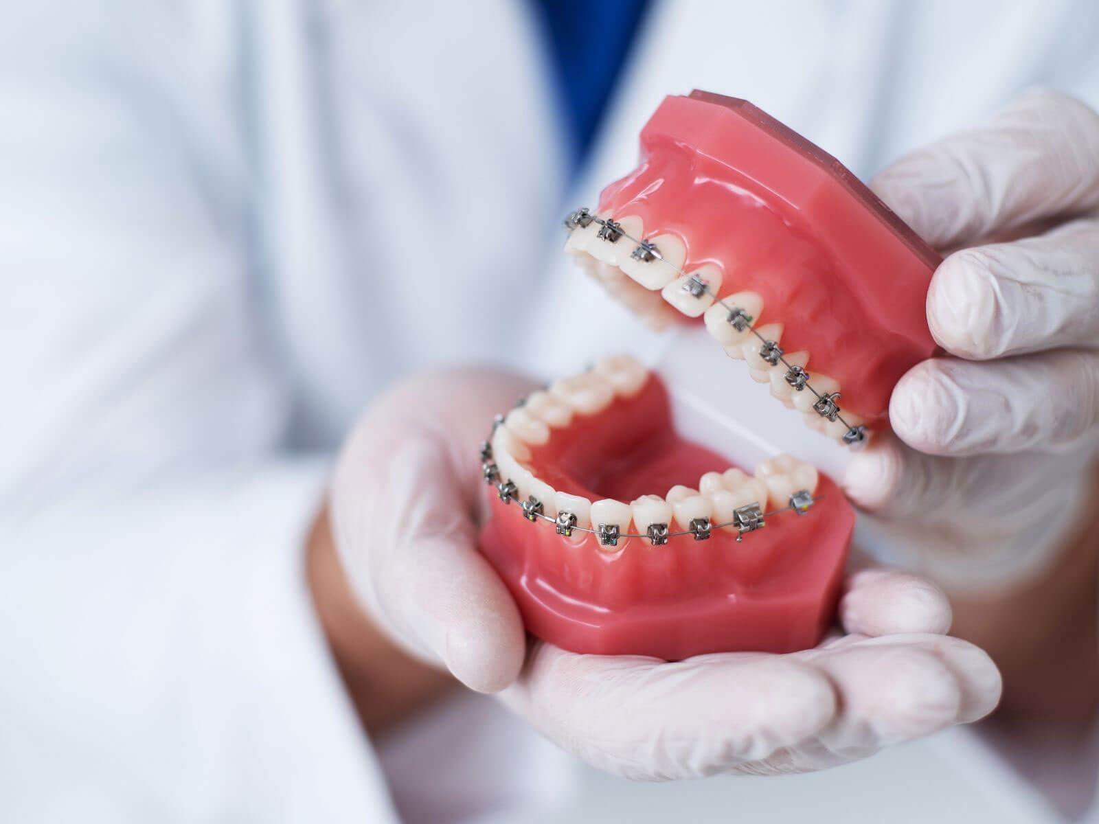 How Long Do You Have to Wear Braces?