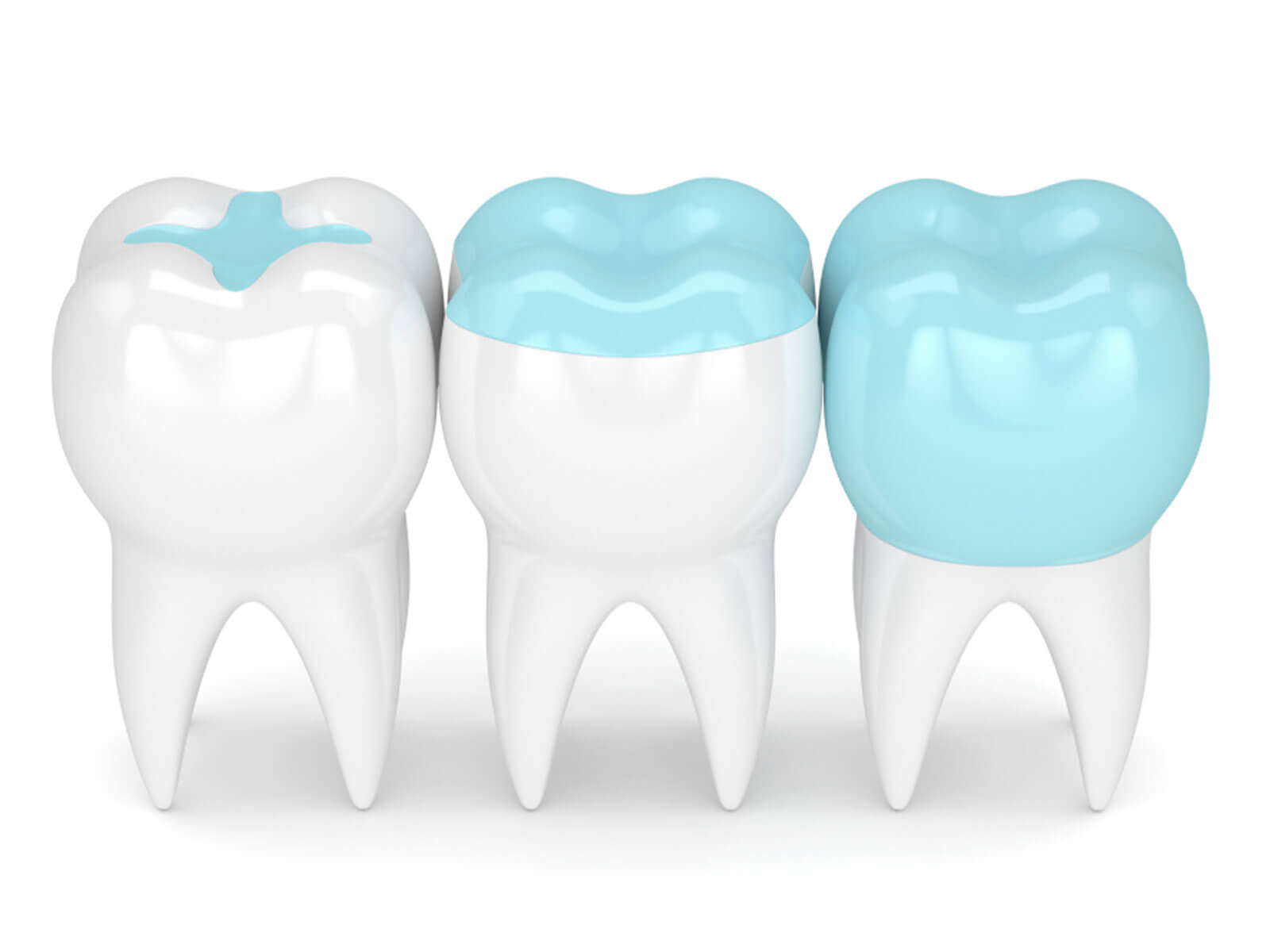 Dental Inlay vs. Filling – Which One Is Right for You?