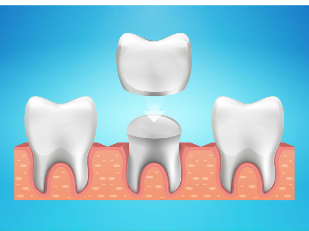 Tooth Crown Pattern Tooth Crown Procedure: Step-by-Step Guide