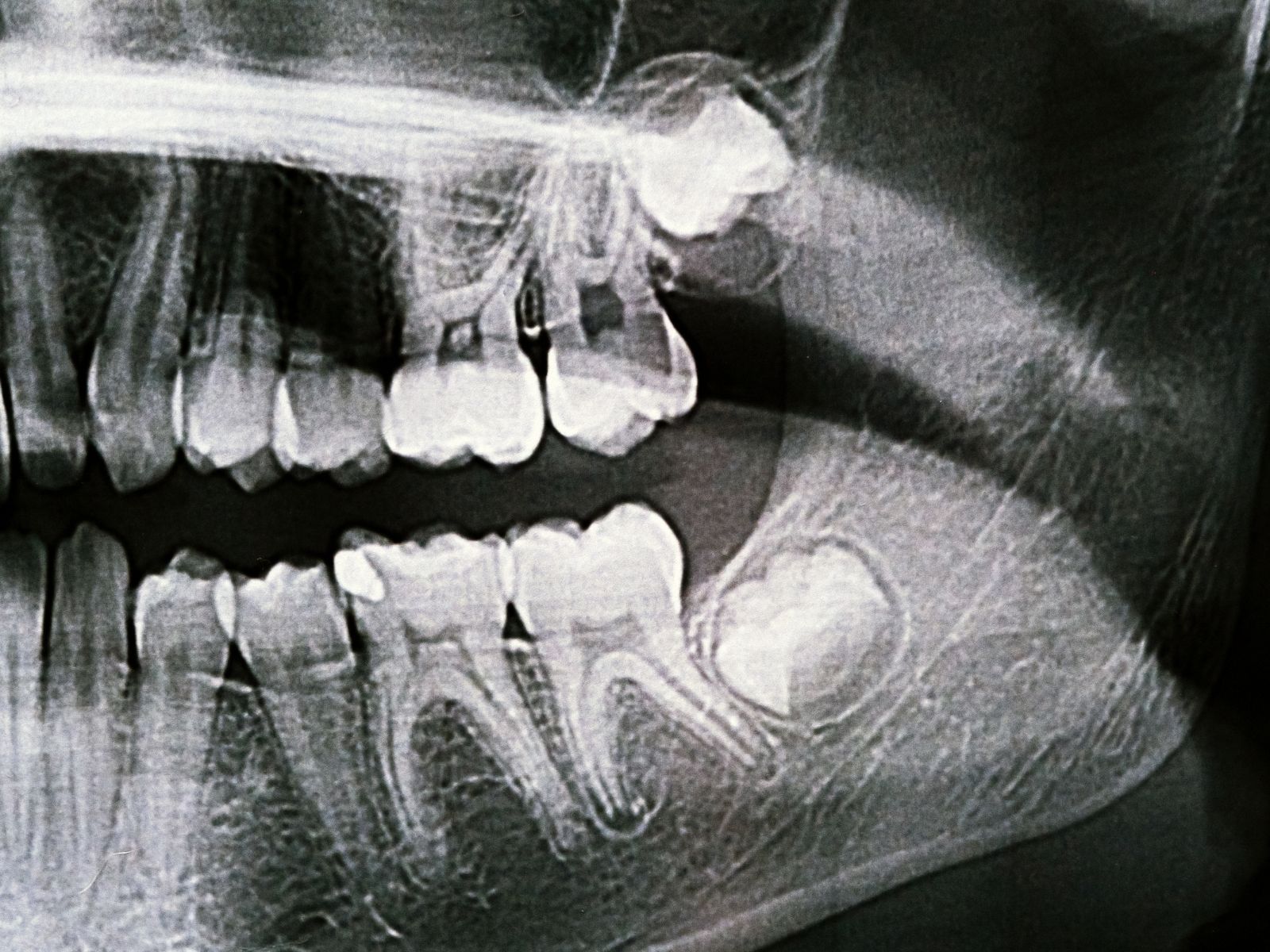 Impacted Wisdom Tooth: How to Spot It and What Treatment Involves