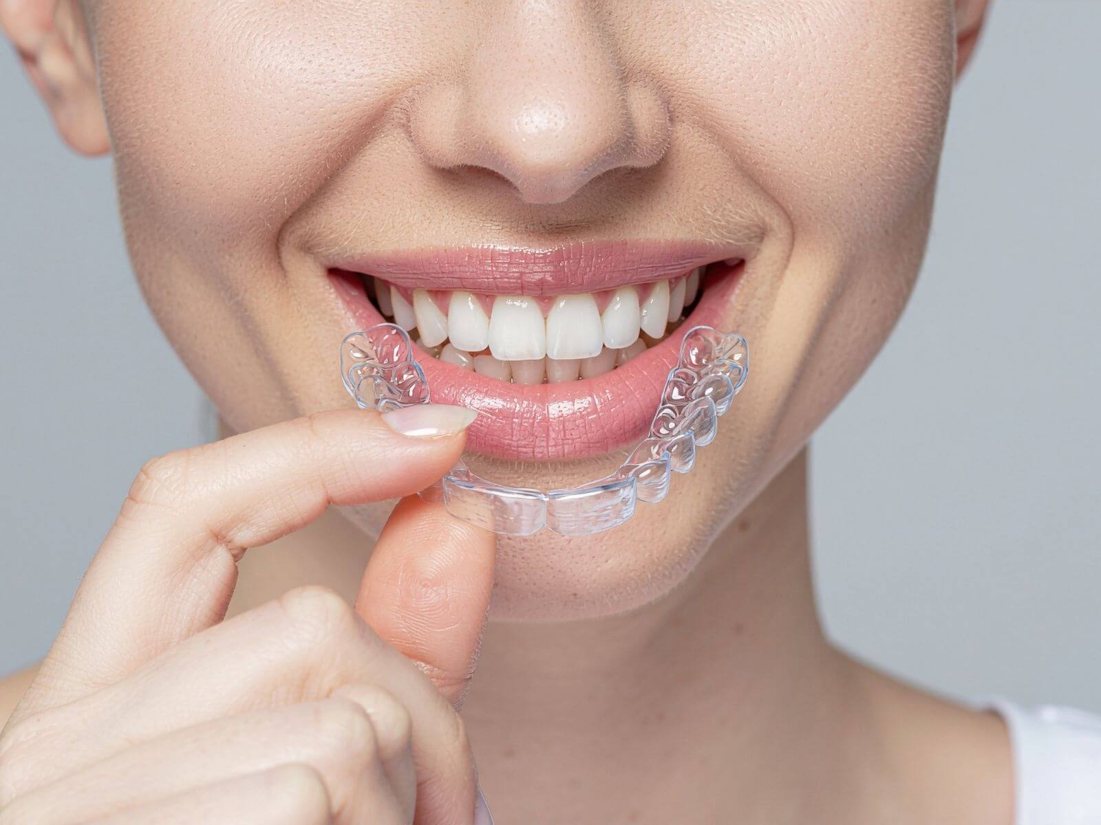 How Does Invisalign Work? Step-by-Step Treatment Process